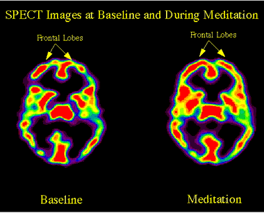 brain scans